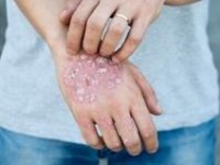 pikkelysömör azaz psoriasis és az aloe vera