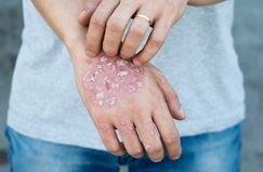 pikkelysömör azaz psoriasis és az aloe vera